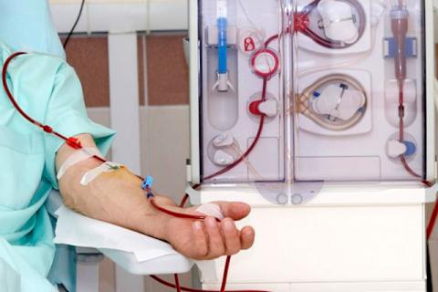 Colocación de catéter permanente para hemodiálisis