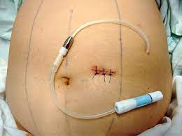 Colocación de catéter Tenckhoff para diálisis peritoneal