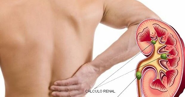 Perfil de litiasis renal